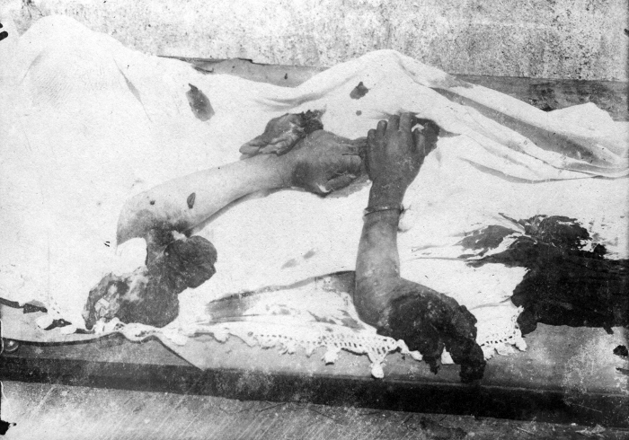 Abgetrennte Gliedmassen massakrierter Griechen - (Ref-Nr. img003)